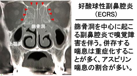 副鼻腔気管支症候群：その多面的な影響と日常への浸透